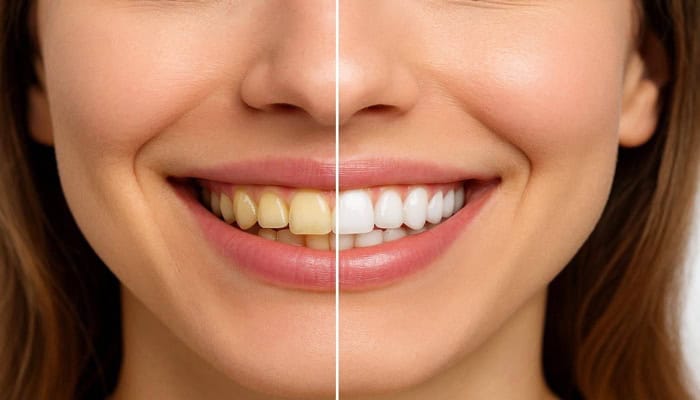 teeth whitening before and after Falls Church VA Grove Dental Clinic